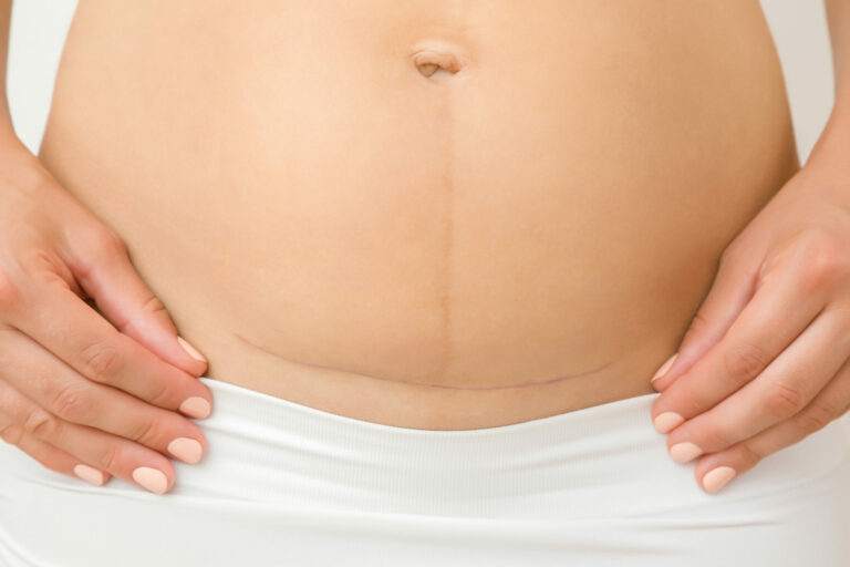 Read more about the article Top 10 Tips for Preparing for Your C-Section